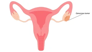 Ovarian Cancer Symptoms