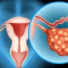 What are causes of ovarian cysts?