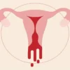 Heavy Bleeding Periods Treatment