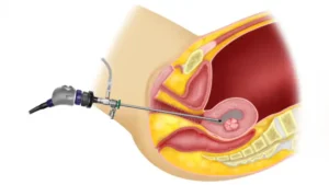 Hysteroscopy Procedure