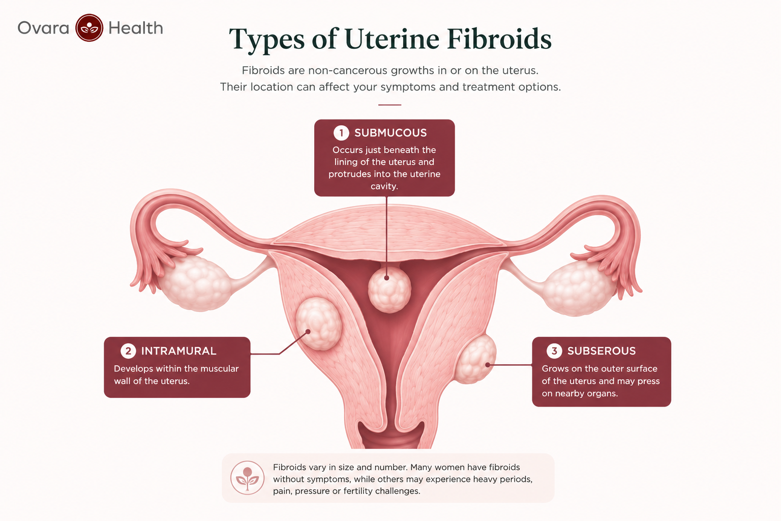 Diagram showing three types of uterine fibroids: submucous, intramural and subserous, and how they cause heavy periods
